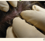 Handling Head Lice: How to Recognize & Treat It